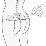 bioplastia de gluteos preenchimento