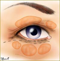 blefaroplastia