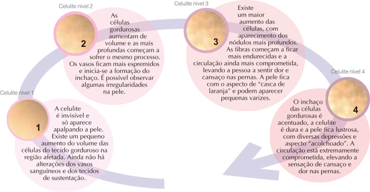 graus da celulite