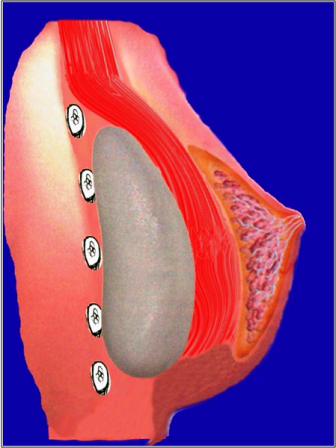 protese de silicone