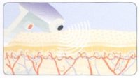 velashape-ii-radiofrequencia-celulite