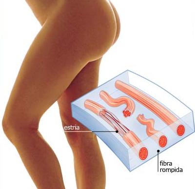 tratamento para estrias 