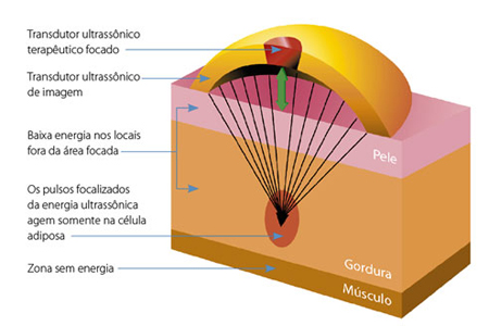 lipo light